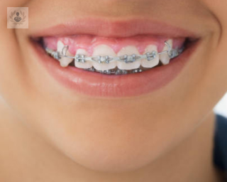 ortodoncia_brackets_oc_dental