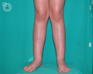 genu valgo piernas niños tratamientos sintomas