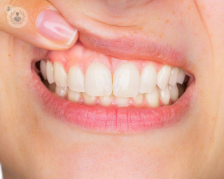 Mujer mostrando dientes y encías 