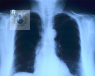radiografía pulmones