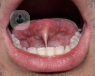 frenillo lingual tratamiento logopedico cirugia