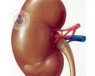 El trasplante renal se puede intervenir mediante un procedimiento convencional, con la realización de anastomosis vasulares o empalmes.