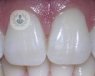 Técnica de implantes dentales All on four para pacientes con poco hueso en el maxilar