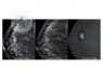 Imagen de una mamografía