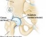 Sustitucion articulacion cadera