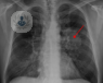 foto cancer pulmon