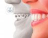 Ortodoncia invisible, una alternativa a los brackets convencionales