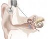 implantes cocleares sordera
