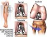 artroscopia rodilla