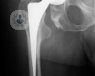 La prótesis de cadera se utiliza en casos de artrosis avanzada