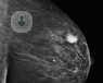 Operación del cáncer de mama sin cicatrices
