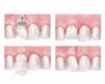 Carillas Lumineers para cambiar forma y color de los dientes