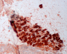 melanoma maligno visto al microscopio