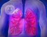 La EPOC es la enfermedad pulmonar obstructiva crónica, y hay de varios tipos como bronquitis, de tipo enfisema, etc. Hay que tratarla y tiene síntomas como la tos cronica