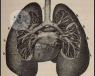 El tabaco es la causa principal del enfisema pulmonar