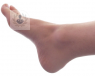 El pie diabético es muy importante controlarlo a tiempo para prevenir la aparición de lesiones. Se caracteriza por la falta de sensibilidad al dolor.