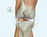La ligamentoplastia consiste en una técnica que se realiza cuando se produce una rotura de ligamentos, y se sustituyen éstos por injertos.
