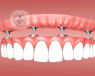 Una base ósea estable es el mejor aliado de los implantes dentales