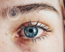 Ptosis bilateral que cubre la mitad de la pupila