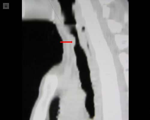 Radiografía de costado de un cuello de paciente - estenosis traqueal by Top Doctors