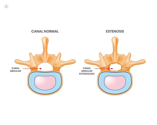 Dos ilustraciones de una vértebra, una sana y una con estenosis de canal - by Top Doctors