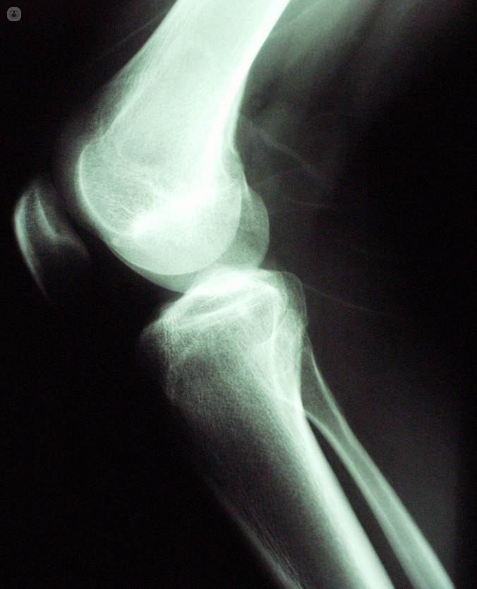 Radiografía de caso de artrosis de rodilla