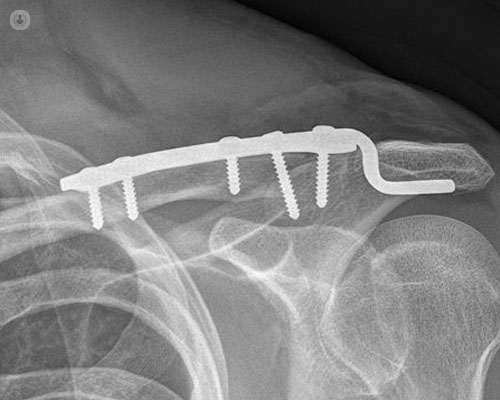 Radiografia de un hombro con un tornillo y placa - Osteosíntesis - by Top Doctors
