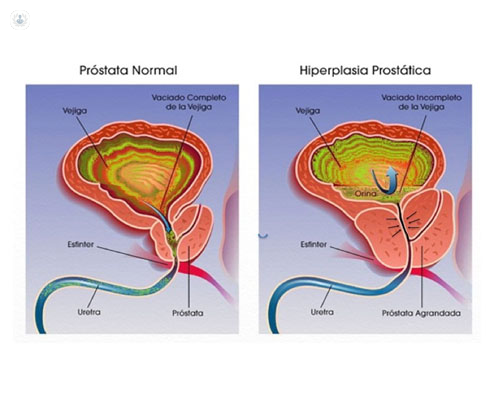 Esquema de próstata normal y próstata con hiperplasia benigna de próstata by Top Doctors