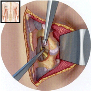 discectomía lumbar percutánea by Topdoctors