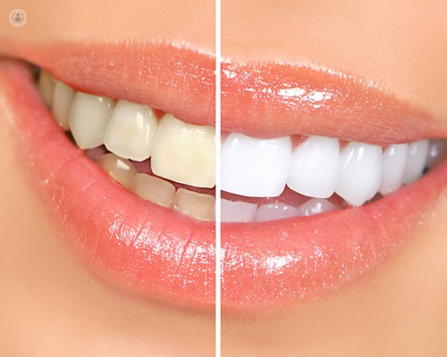 Antes y después de un blanqueamiento dental by Top Doctors