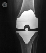 La protesi di ginocchio è sempre più sicuro dal progresso