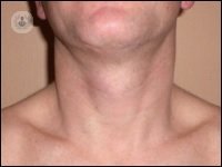 Simple goiter is an increase in the size of the thyroid that is currently related to immune problems