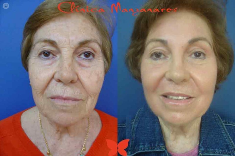 La doctora Martin Núñez presenta un nuevo tratamiento de rejuvenecimiento facial sin cirugía exclusivo de la Clínica Manzanares, de Alicante.