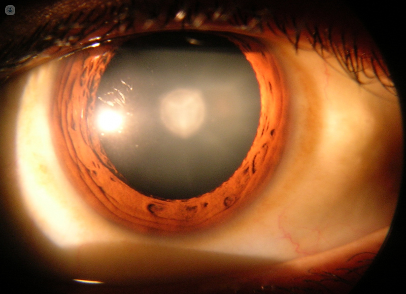 Узнайте о преимуществах фемтосекундного лазерной хирургии катаракты и пресбиопии.