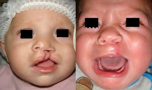 before and after cleft lip
