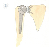 Anatomical shoulder prosthesis