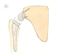 Reverse shoulder prosthesis