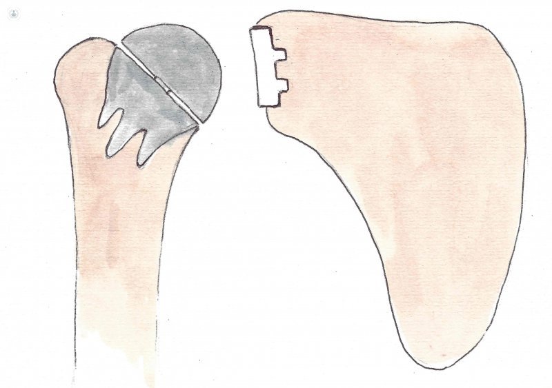 Total shoulder prosthesis rodless