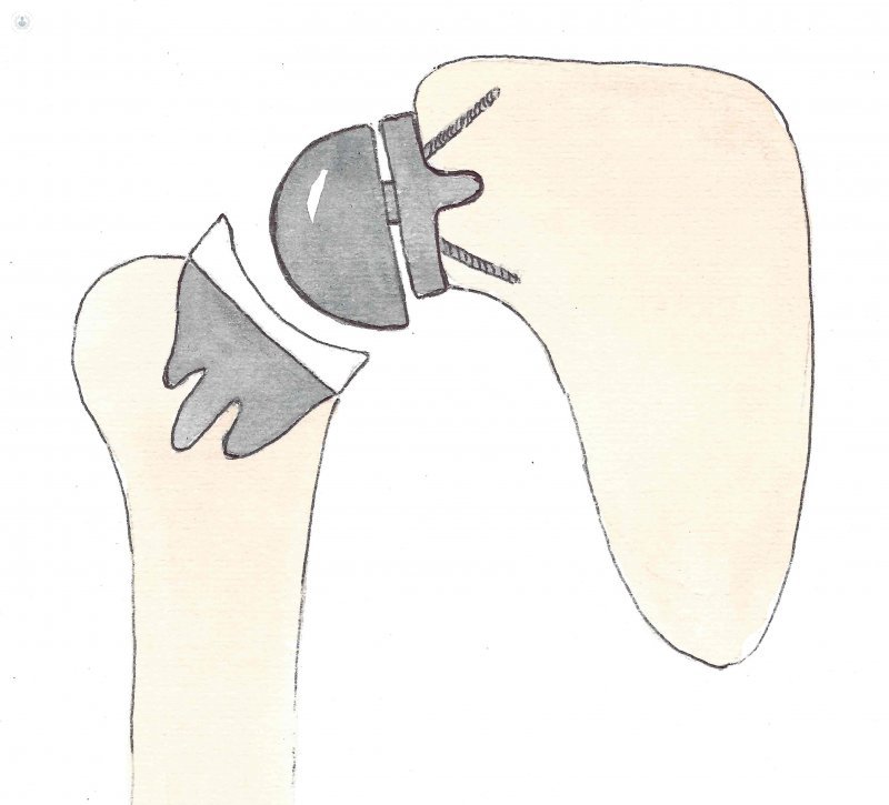 Reverse shoulder prosthesis rodless