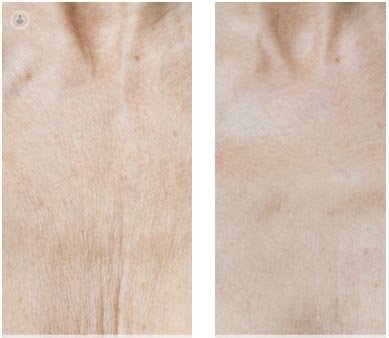 La mesoterapia facial, tratamiento ara mejorar la firmeza de tu piel y eliminar las arrugas