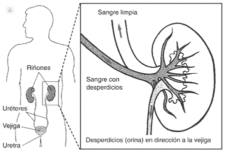 kidney extirpation