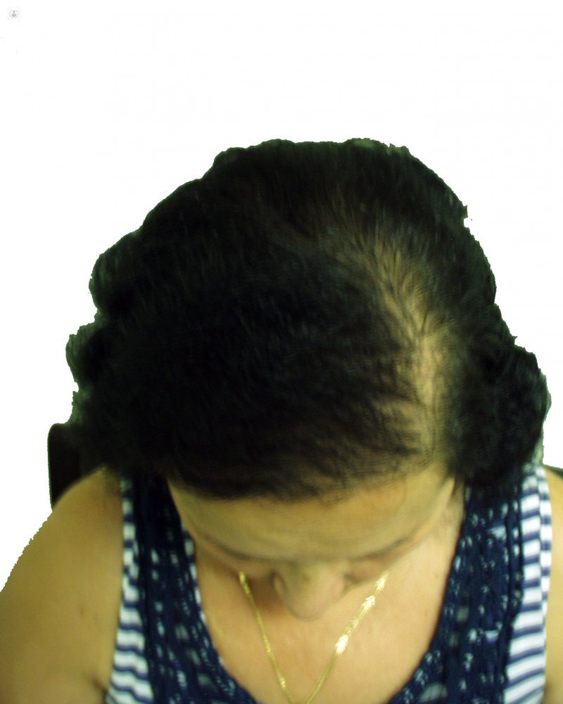 alopecia femenina