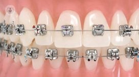 Conoce las diferencias entre los tipos de ortodoncia: lingual, traidicional e invisible en este artículo.