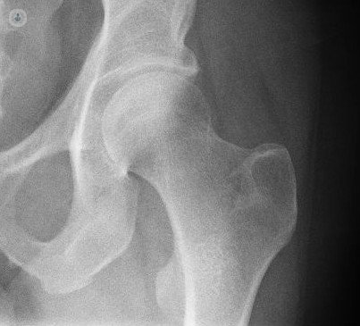 ¿Cómo identificar la artrosis de cadera?