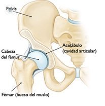 Sustitucion articulacion cadera