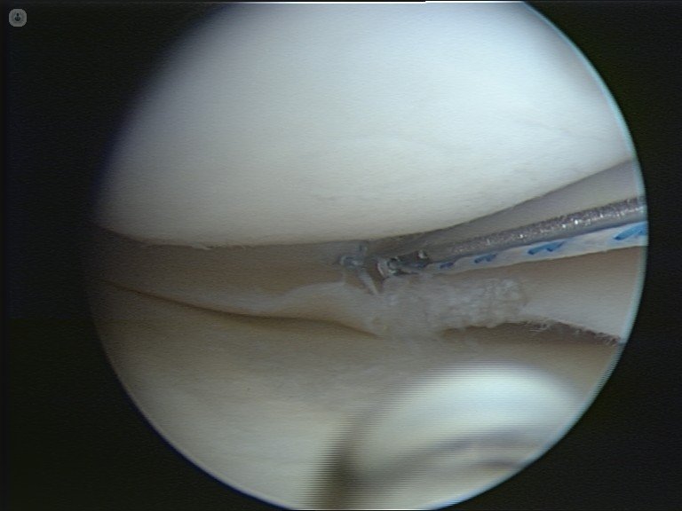 Retura image meniscus