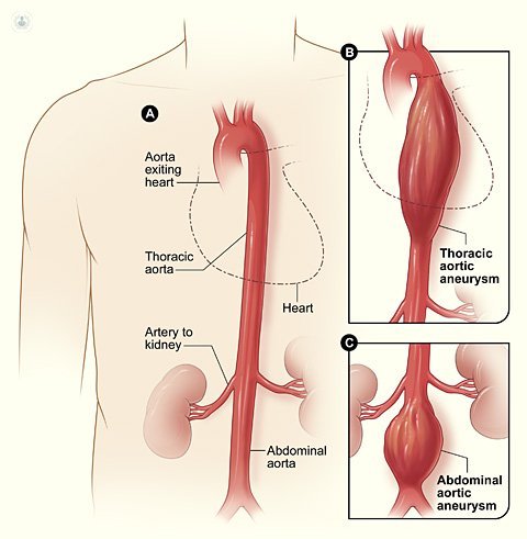 аорты Аневризма тела