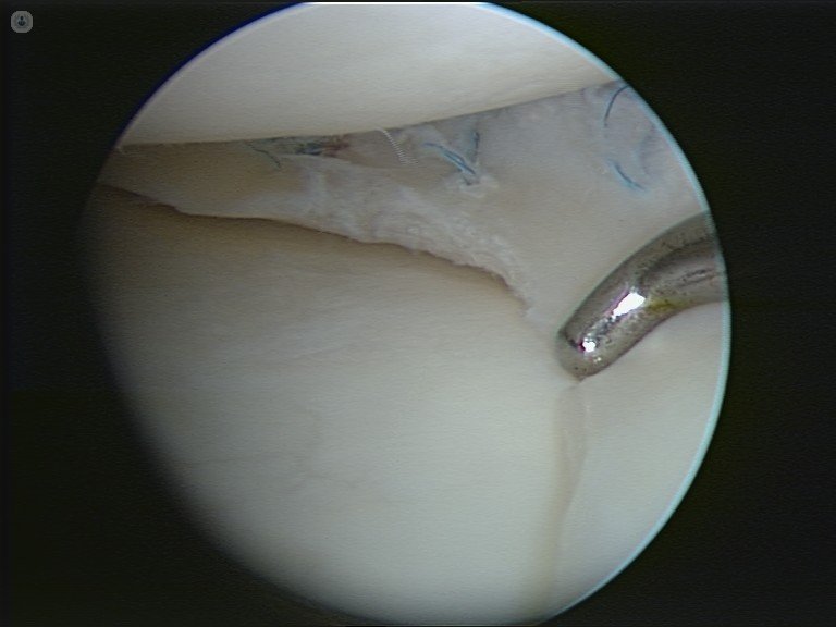 arthroscopy meniscus