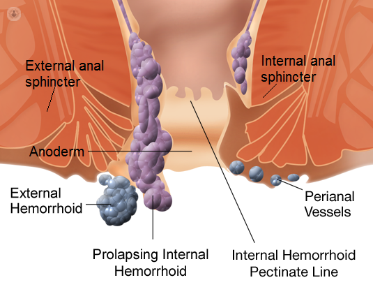 hemorrhoids image