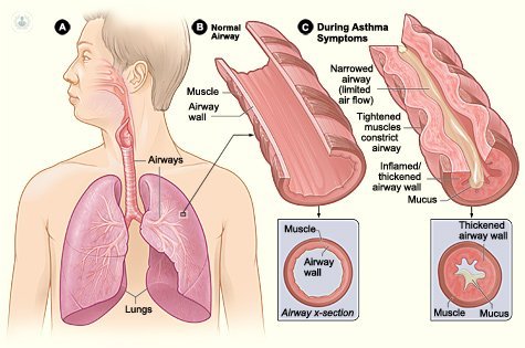 spiegazione asma